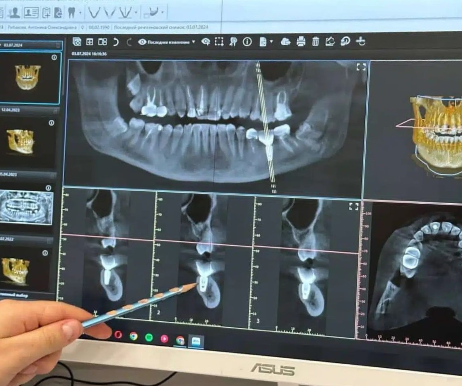 Комп'ютерна томографія зубів (КТ зубів)