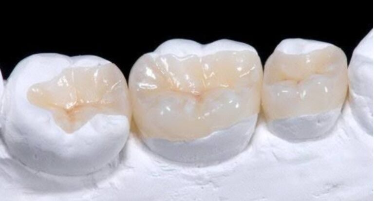 Керамічні накладки