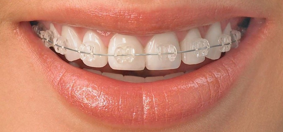 керамічні брекети